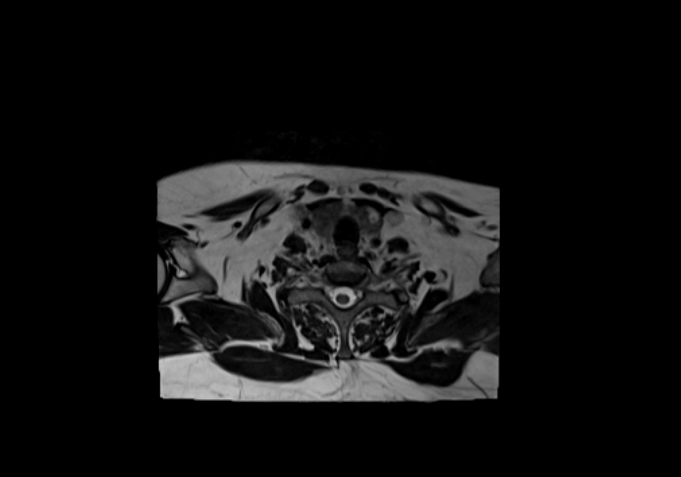 Neck axial  lymph node cross sectional MRI anatomy 3T MRI  image-img-00001-00086.webp